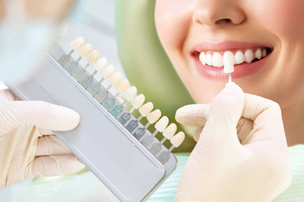 Teeth Whitening in Riyadh