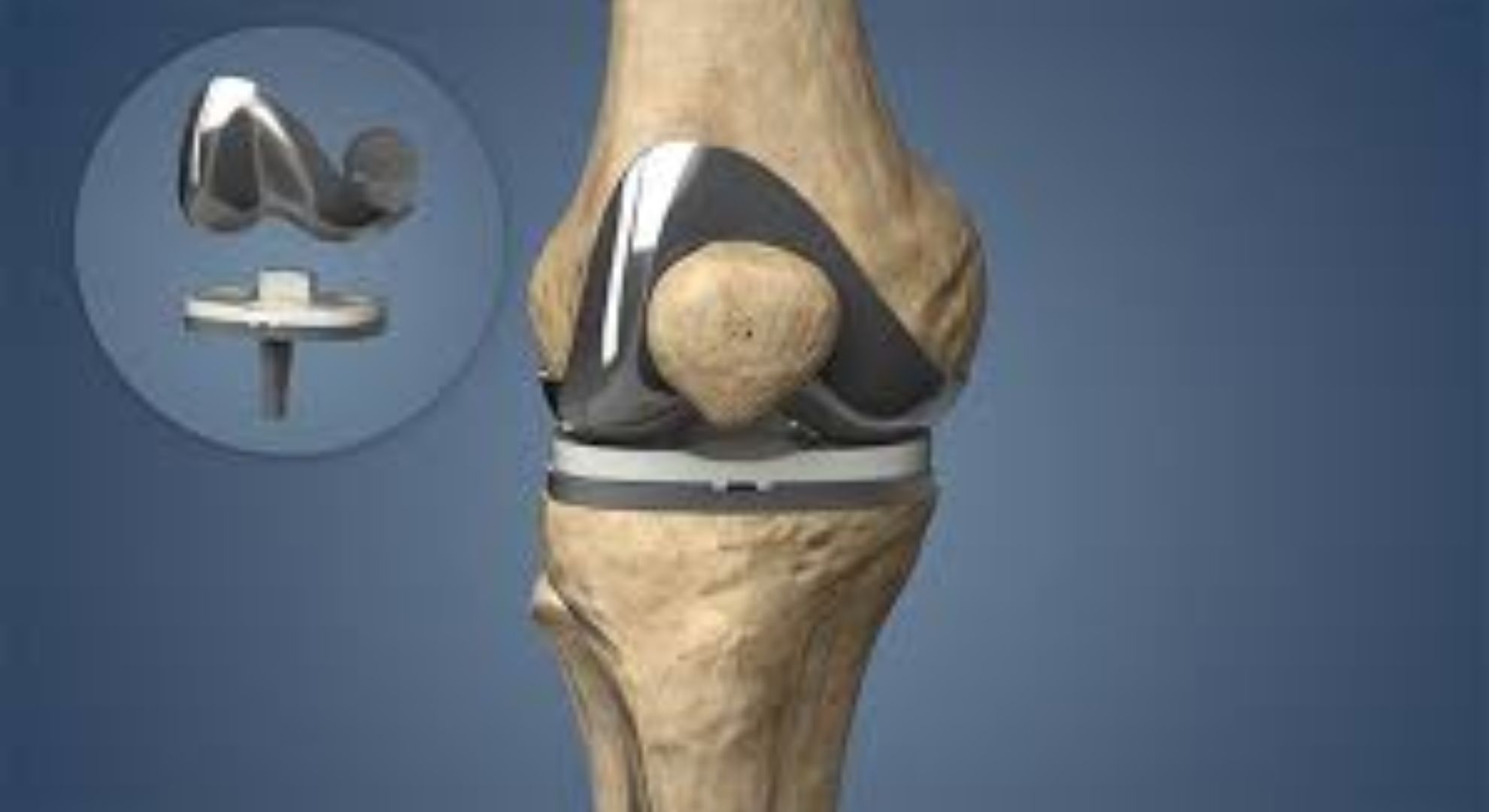 knee replacemet Treatment image