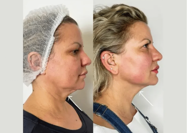 Endolift Treatment in Dubai: Perfect for Busy Professionals