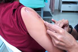 Keloid Scar Removal in London: Treatments, Costs & Expert Care in the UK