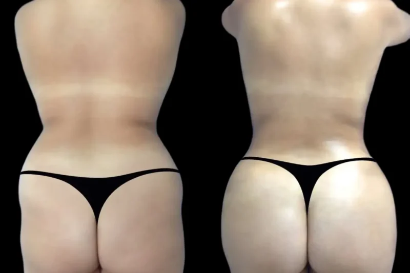 Hyacorp Fillers Treatment in Dubai: Cost, Benefits, and Real Patient Reviews