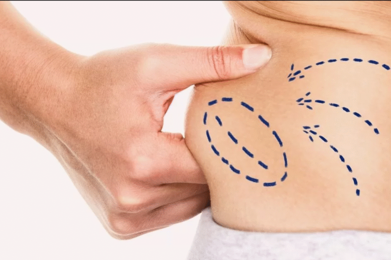 Get Sculpted Liposuction by Best Liposuction Surgeons in Dubai