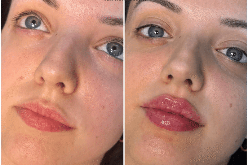 Best Doctors in Dubai reveal the truth about Juvederm fillers