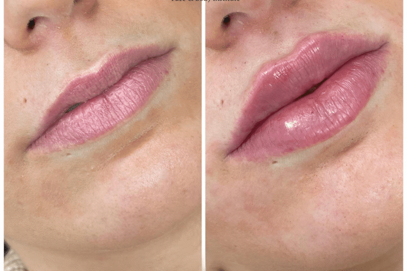 Juvederm for Chin Contouring by the Best Plastic Surgeon in Dubai