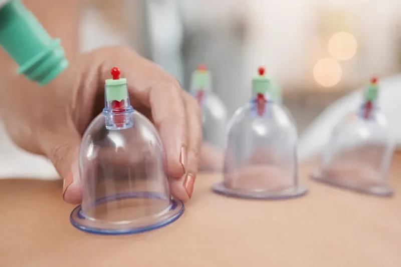 The Ancient Healing Practice Reimagined: Cupping Therapy Dubai