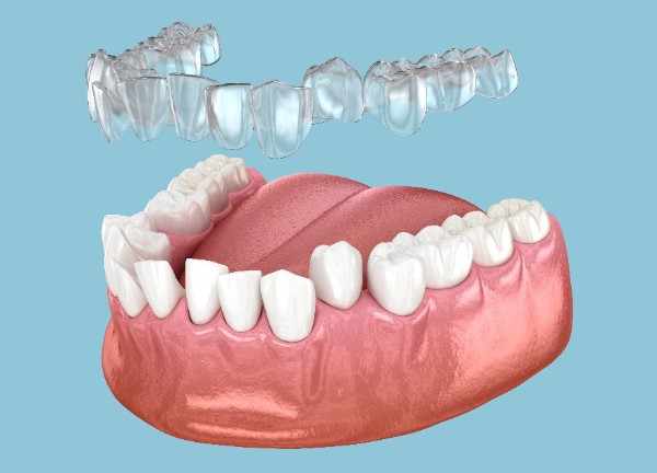 Invisalign