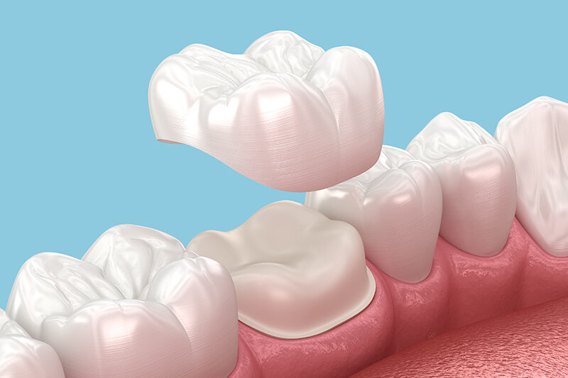 Dental Crowns and Bridges Dubai – Natural & Lasting Results