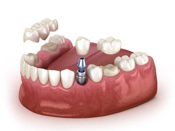 dental implants Bolton