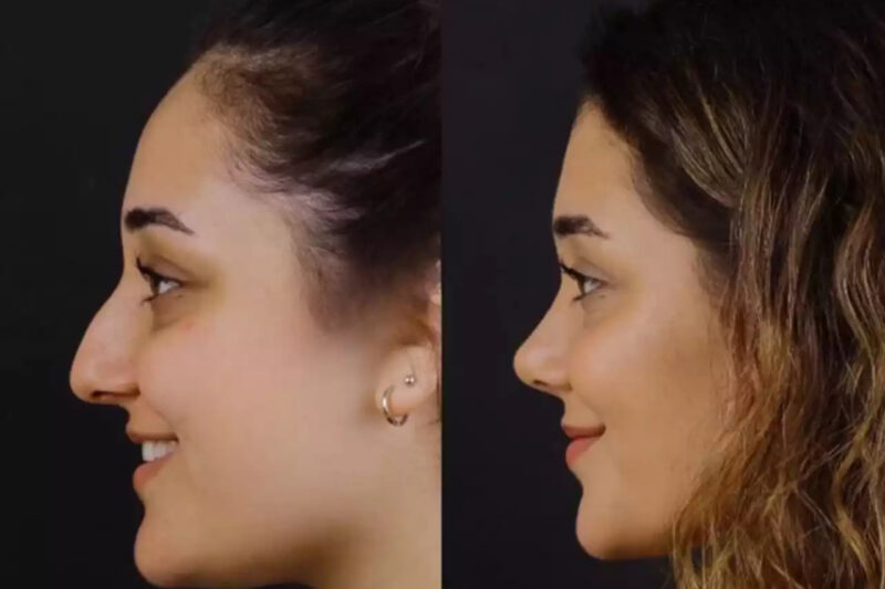 The Best Septoplasty Surgeons in Dubai: Experts in Functional Perfection