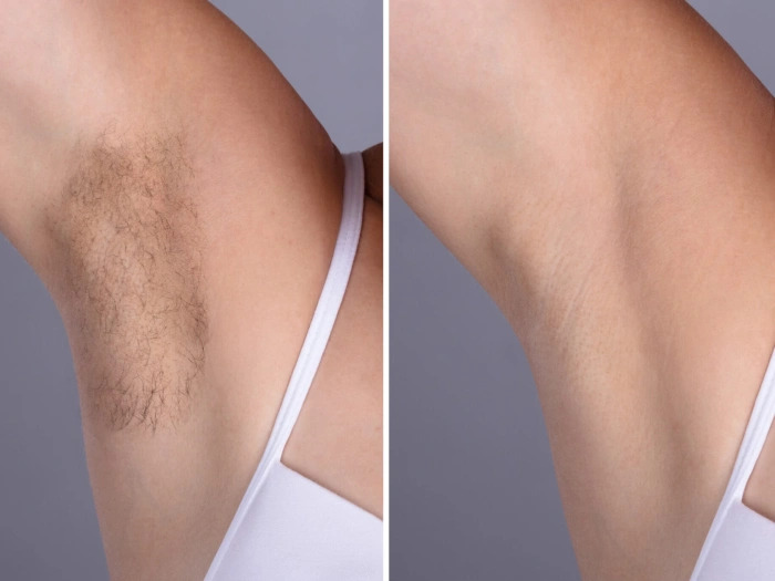 Laser Hair Removal Treatments in Dubai: Your Guide to Permanent Results