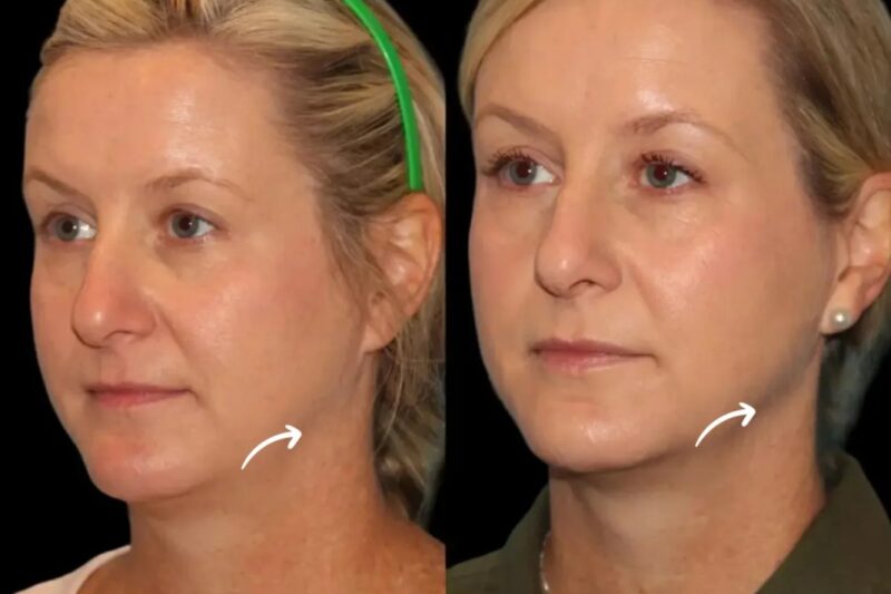 Sculptra Longevity Tips from Best Plastic Surgeons in Dubai