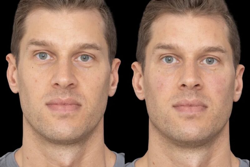 Are Under Eye Fillers Worth It? from Best Aesthetic Clinics in Dubai