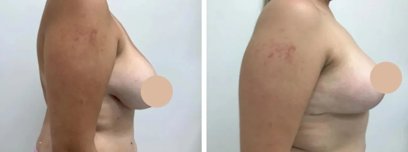 breast lift in dubai