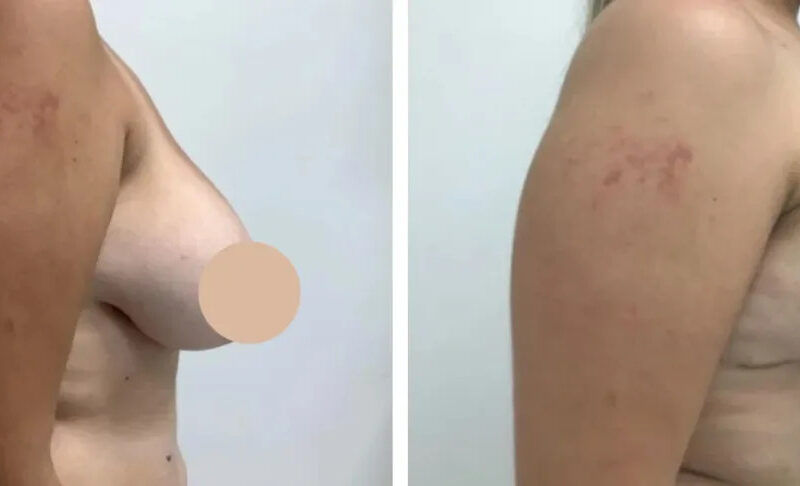 Mastery of the Best Breast Reduction Surgeons in Dubai