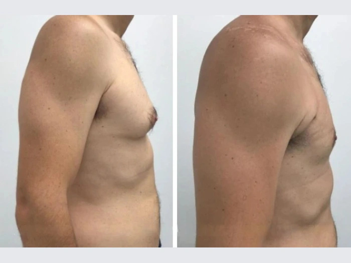 Best Gynecomastia Surgeons in Dubai Using Advanced Laser Techniques