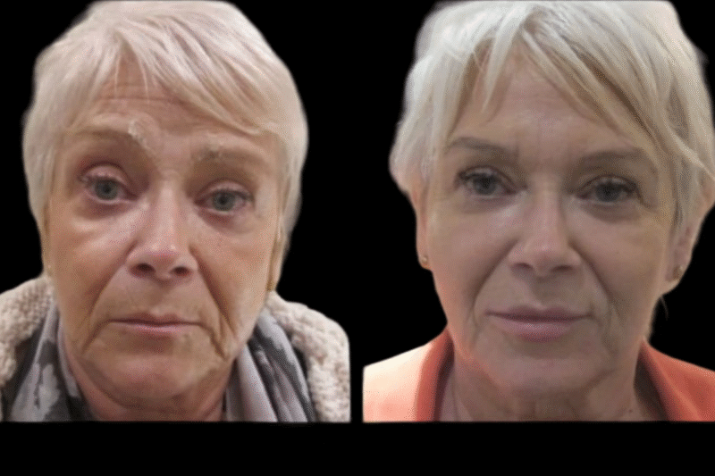 Are Jawline Fillers Treatments in Dubai Reversible?