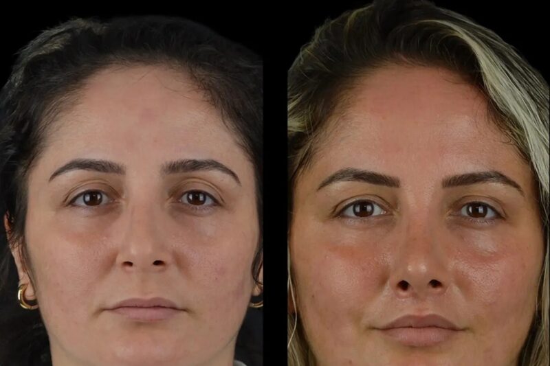 How to Get Sculpted Cheek Fillers Natural at the Best Aesthetic Clinics in Dubai