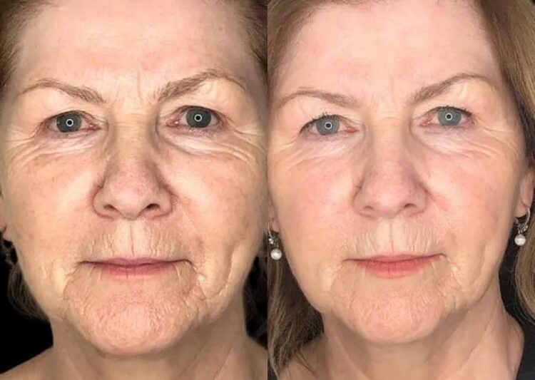 Profhilo Perfection with the Best Plastic Surgeon in dubai