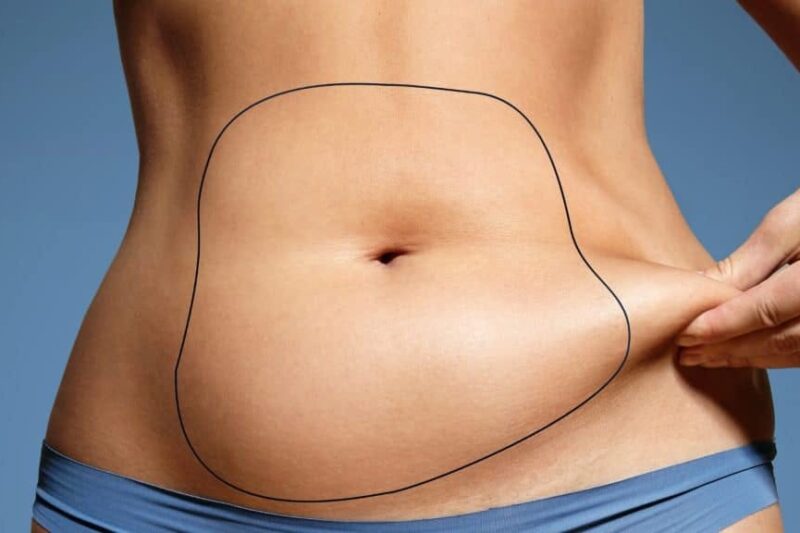 Consultation to Recovery from Best Liposuction Surgeons in Dubai