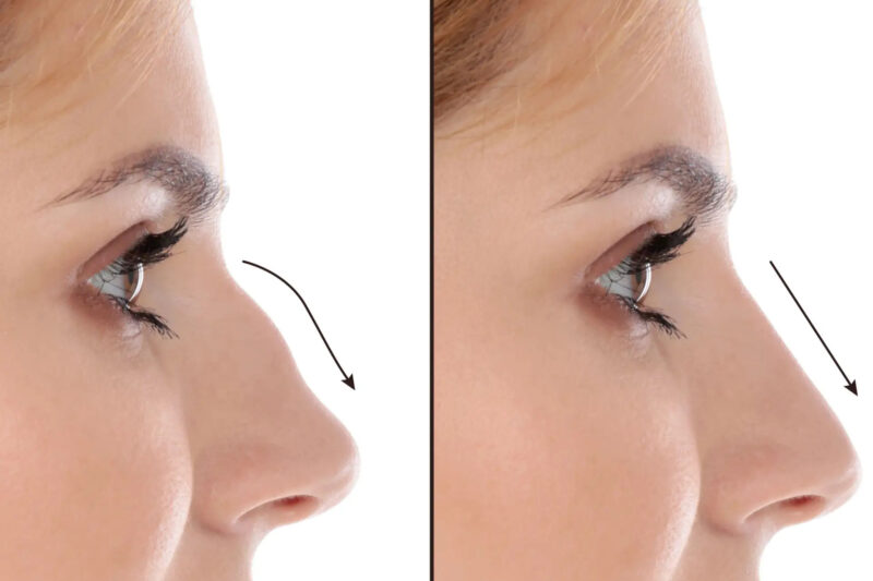 Transform Your Reflection with the Best Rhinoplasty Surgeon in Dubai