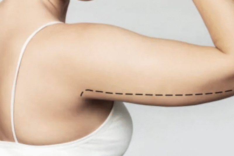 Arm Liposuction in Dubai – Combining Luxury and Care