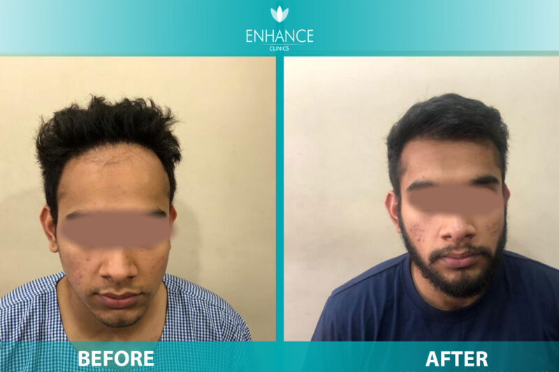Hair Transplant Delhi: Your Complete Guide to Restoring Confidence and Natural Hair