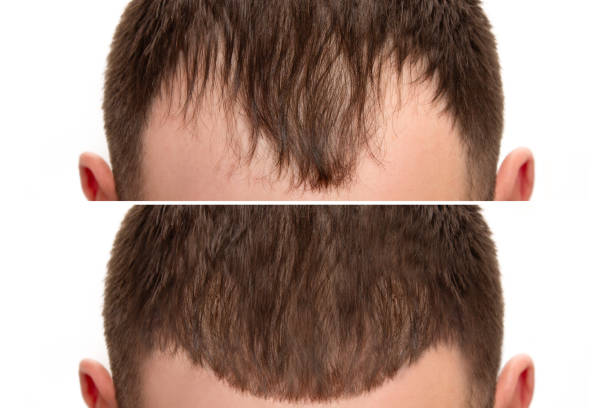 Hair transplant in Dubai