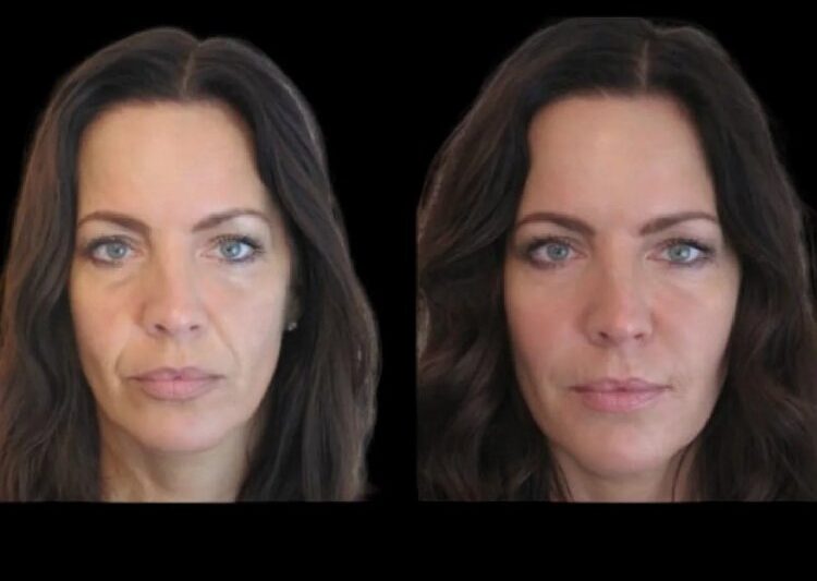 Jawline Fillers in Dubai: A Non-Invasive Way to Achieve Facial Perfection