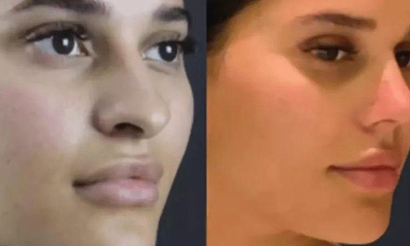 Best Septoplasty Surgeon in Dubai: Combining Function with Patient Comfort