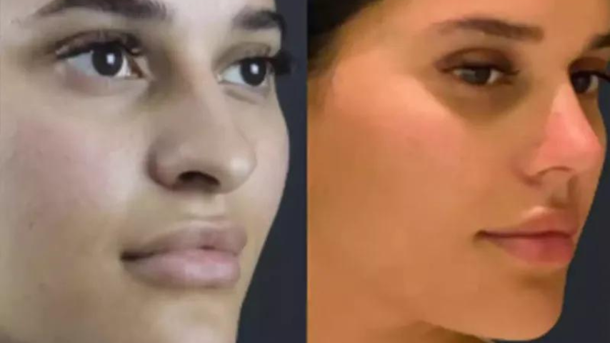 best septoplasty surgeon in dubai