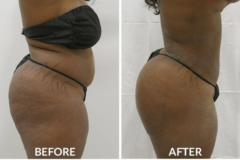 How Long Is the Recovery After a Brazilian Butt Lift in Houston?
