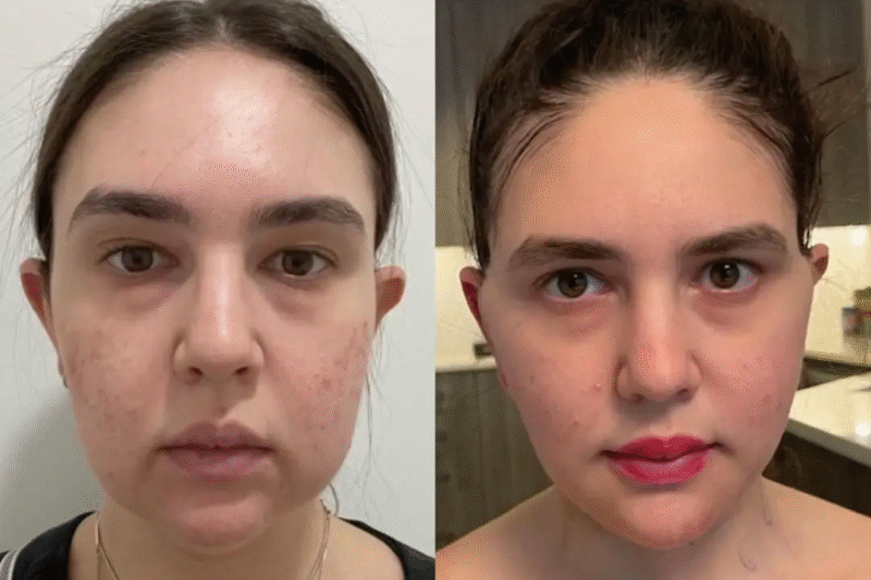 Best Buccal Fat Removal Surgeon in Dubai for Men