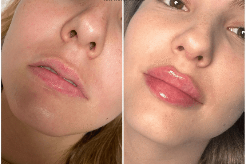 Which Brand to Choose? – Juvederm Treatments in Dubai