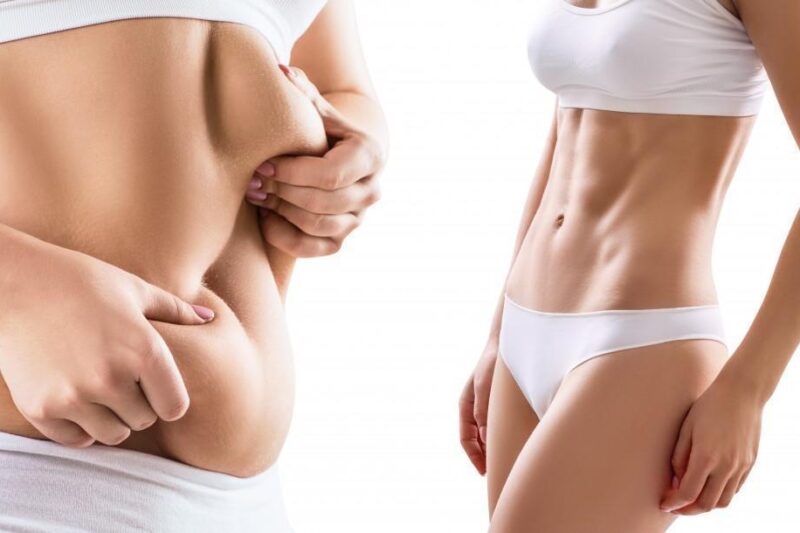 Ultimate Guide to Surgery from Best Liposuction Doctors in Dubai