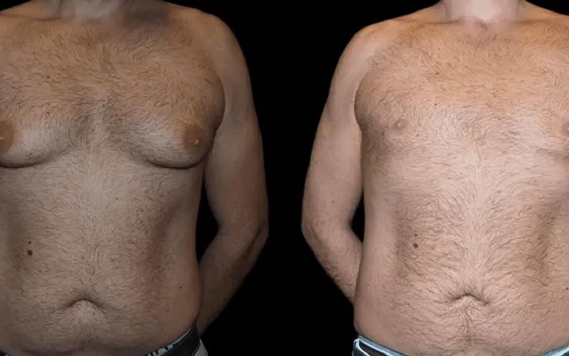 Precision and Perfection: Gynecomastia Surgery in Dubai