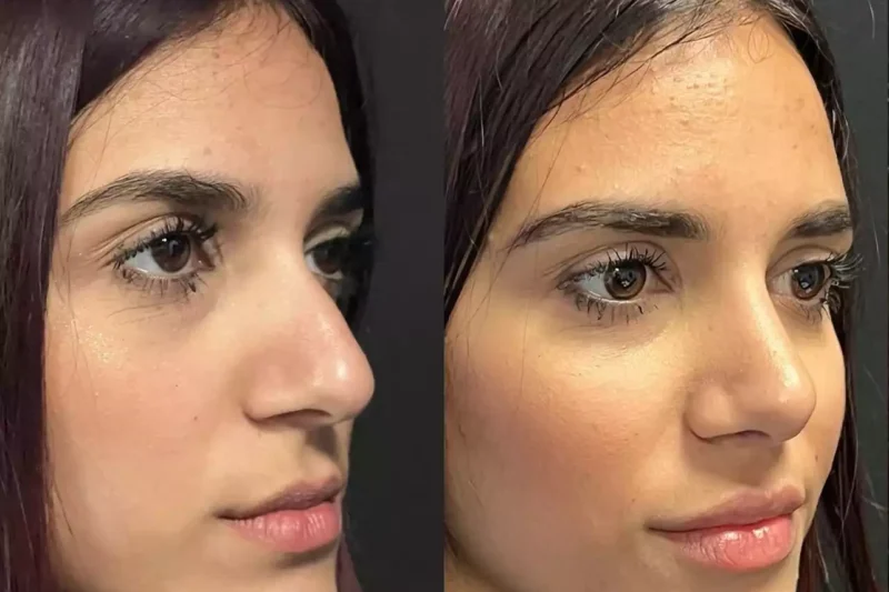 Septoplasty in Dubai: Trusted Treatment for Functional Nose Issues