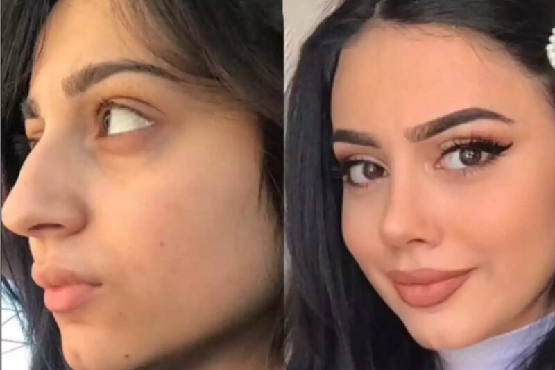 Achieving Natural Beauty Through Advanced Rhinoplasty in Dubai