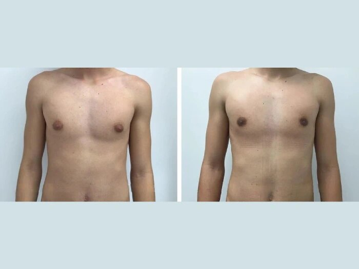 Premium Results Worth the Cost: Best Gynecomastia Surgeons in dubai