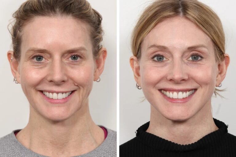 Thread Lift for Sagging Lower Face by the Best Plastic Surgeon in Dubai