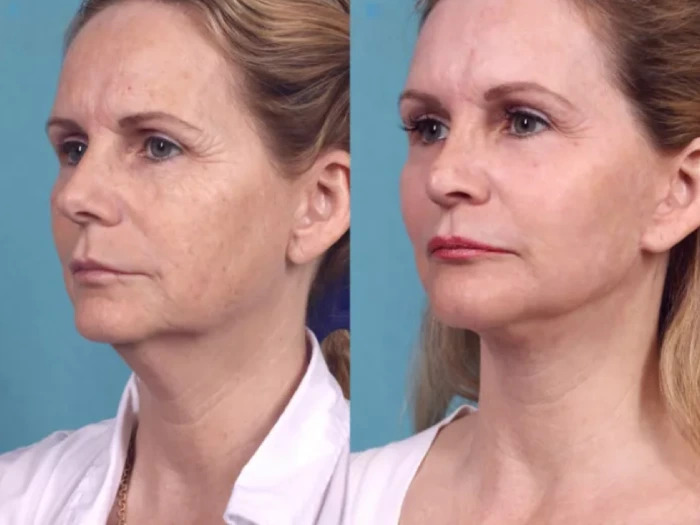 Best Doctors in Dubai for Chemical Peels: Expert Tips for Aftercare