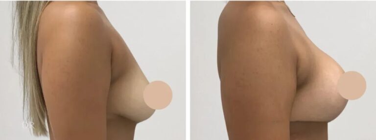 H3-Breast-Lift