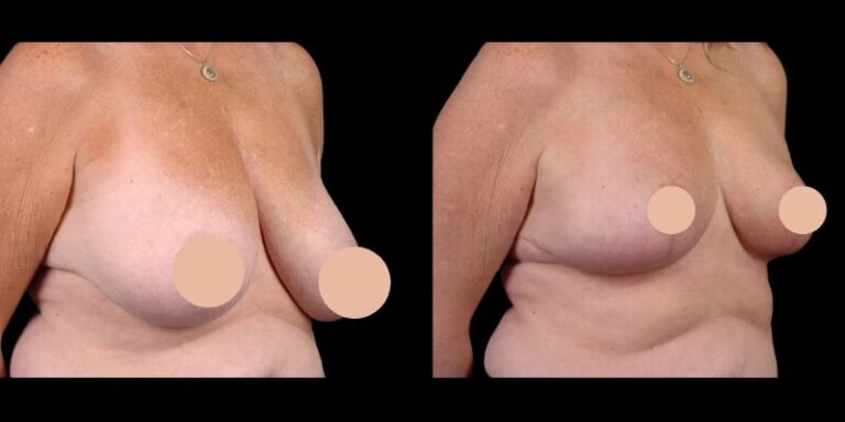 H5-Breast-Reduction