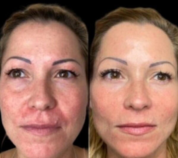 Refreshs Skin Vitality using the Profhilo and Best Doctors in dubai