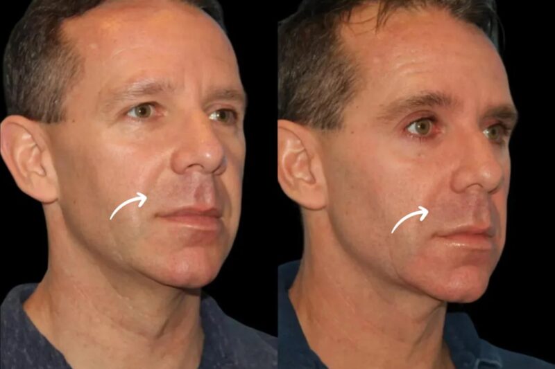 Sculptra Clean Lift by Best Plastic Surgeon Dubai