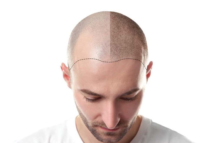 PRP Hair Treatment in Pune: A Natural Path to Stronger, Fuller Hair