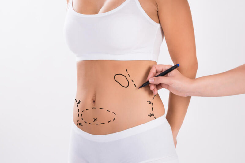 Inside the Patient Journey with Best Liposuction Surgeon in Dubai