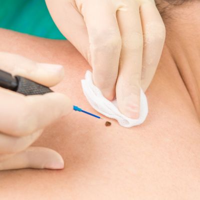 Is Mole Removal Considered Safe for Individuals with Darker Skin Tones