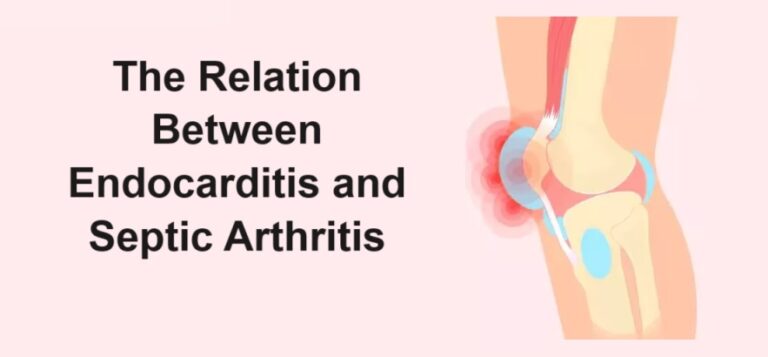 The Relation Between Endocarditis and Septic Arthritis
