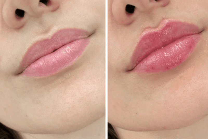 How Juvederm Enhances Facial Contouring at the Best Aesthetic Clinic in Dubai
