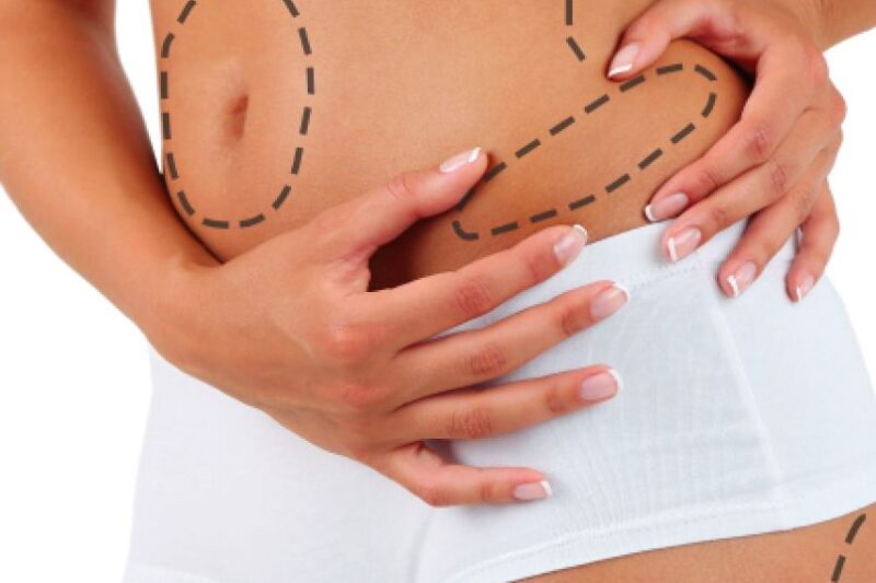 A Minimally Invasive Path to a Flatter Tummy